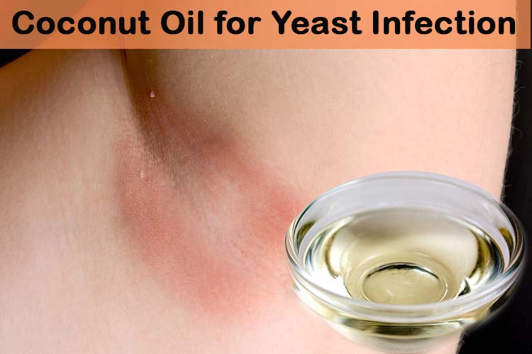 should-i-use-cocunut-oil-for-yeast-infections-health-guide-reviews